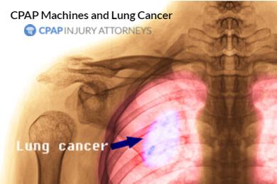 CPAP injury attorneys - Lung Cancer